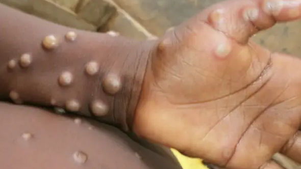 Belgium monkeypox cases linked to fetish festival