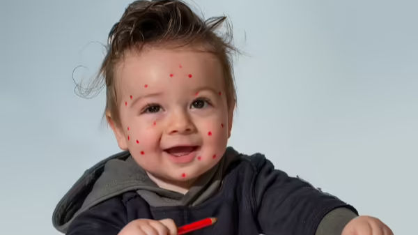 Google honours chickenpox vaccine pioneer’s birth anniversary with doodle