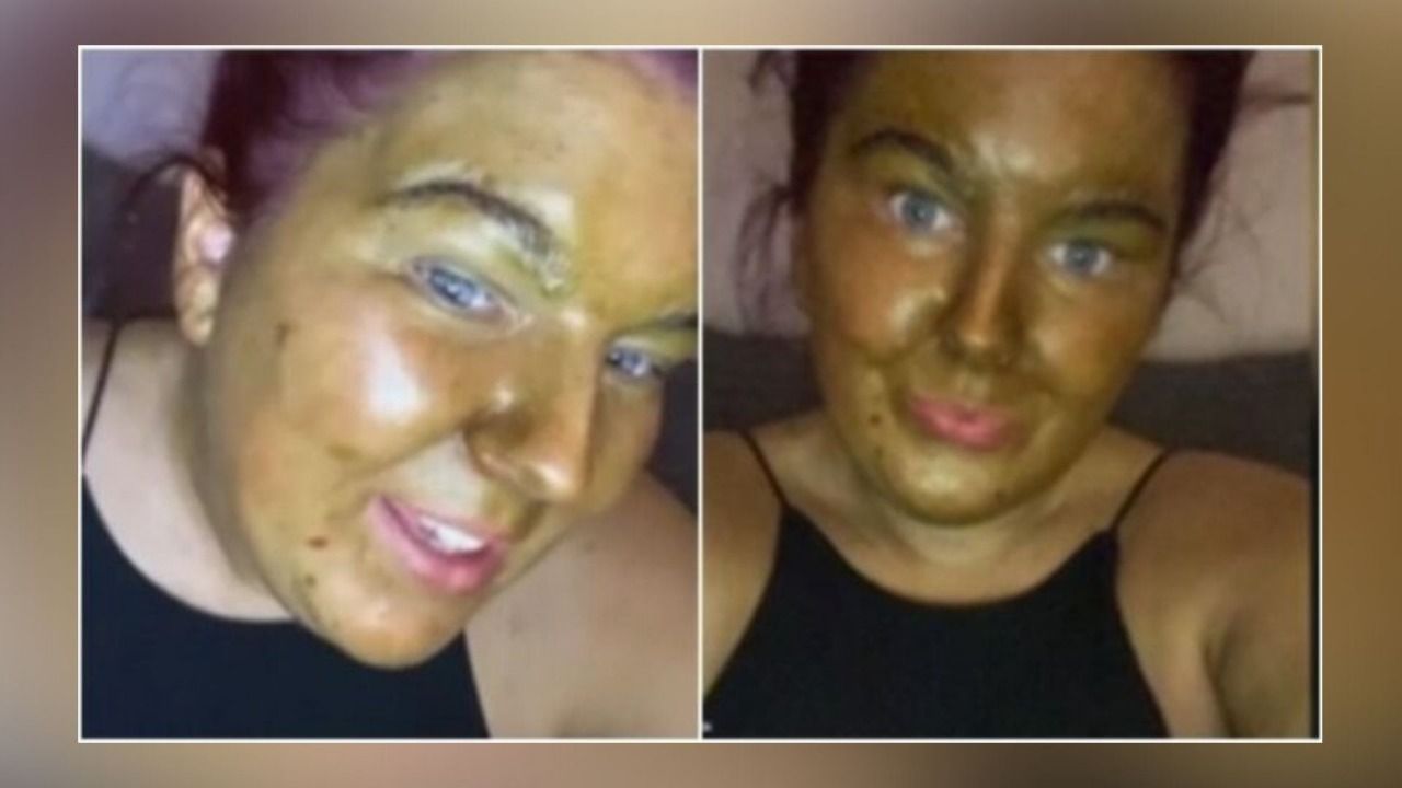 She-Hulk is real? Woman’s face turns green after using fake tan on pale skin