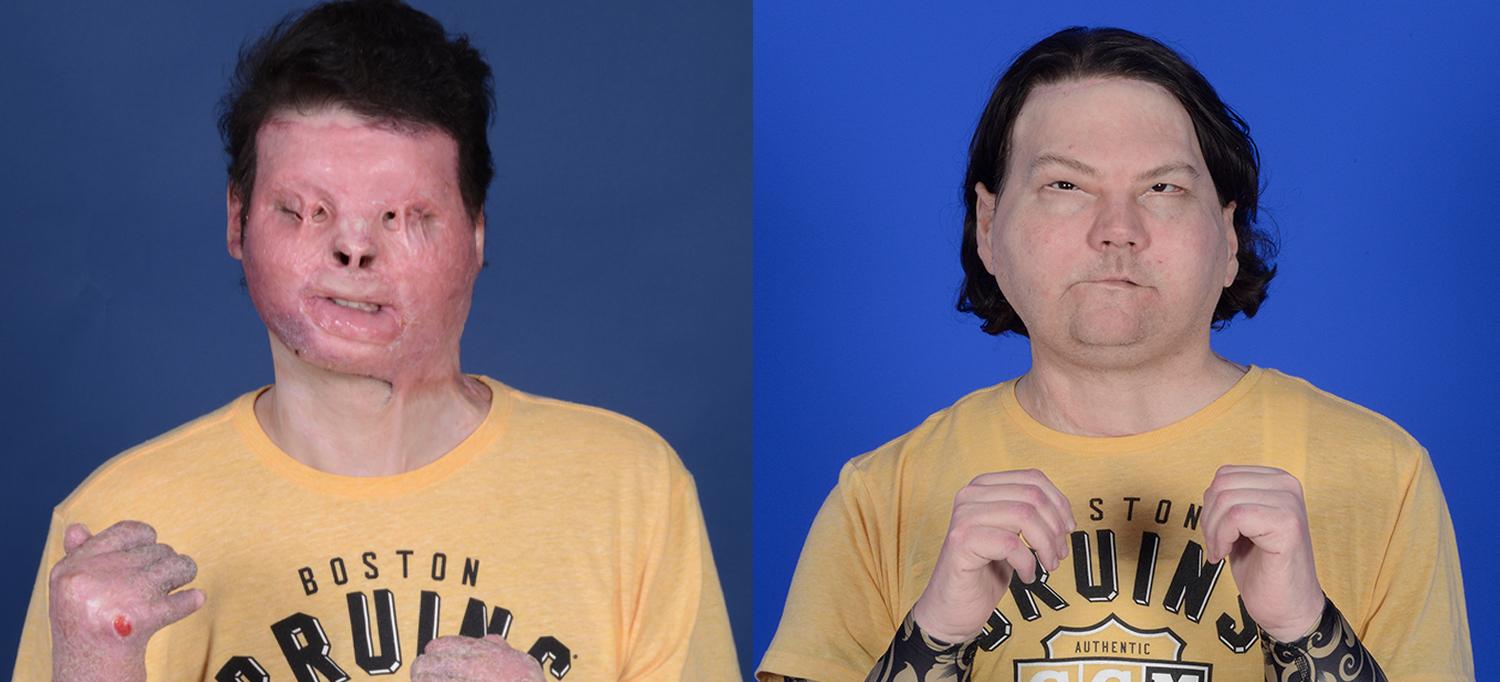 Extremely rare face and hands transplant gives 22-year-old New Jersey man a new lease of life