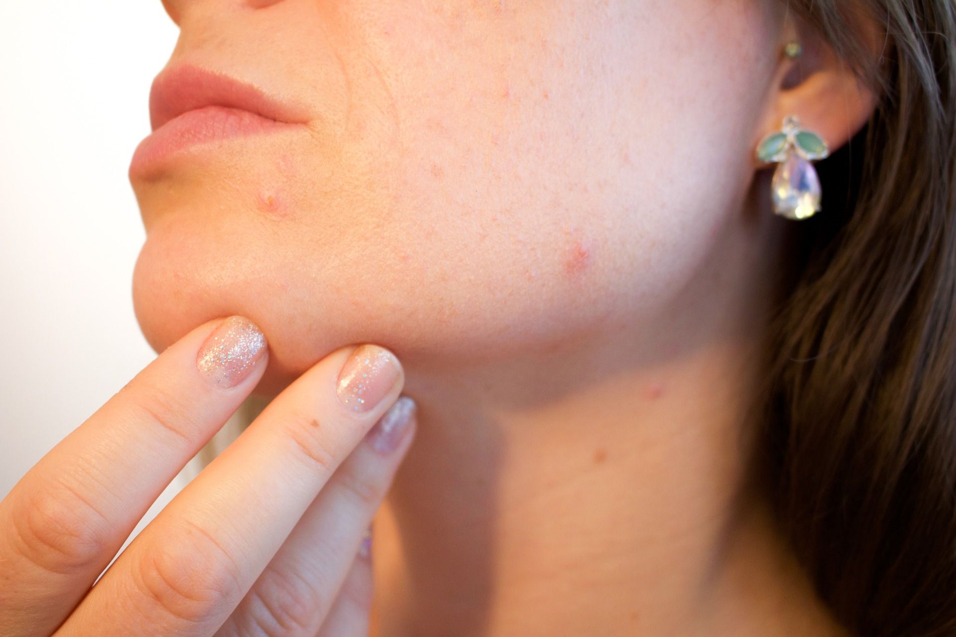 Study finds 29 new acne risk genes, paves way for better treatment