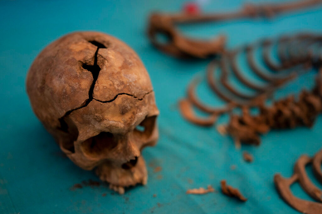 Archaeologists find evidence of world’s first ear surgery in ancient skull