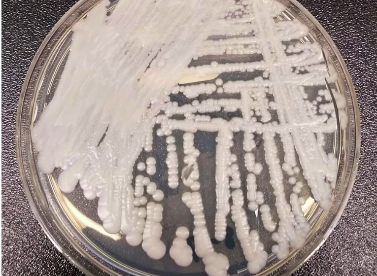 What does Candida Auris look like on the skin? All about deadly fungus spreading, prevention, symptoms and more